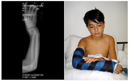 1500-broken-arm.jpg